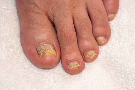 Mycotic Nail Infections