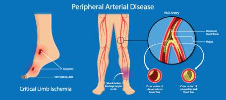 Peripheral Arterial Disease PAD