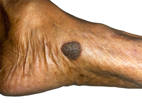 Skin Cancer sof the Feet